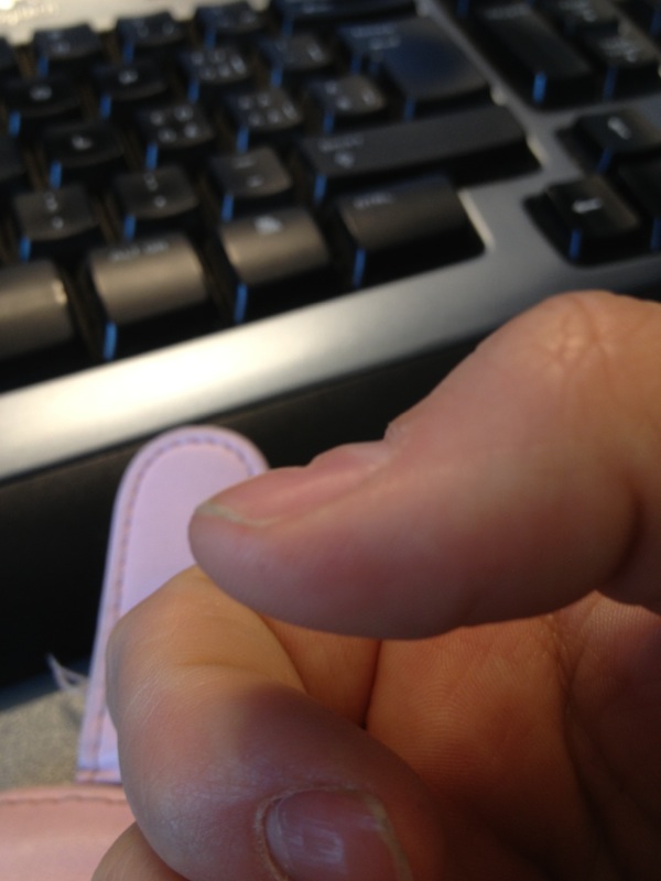 Le psoriasis de coude de la photo